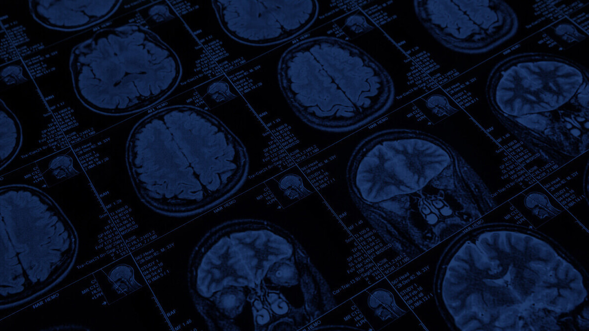 Röntgen-Stereogrammetrie (RSA) betrieben von Machine Learning als Alternative zur CT